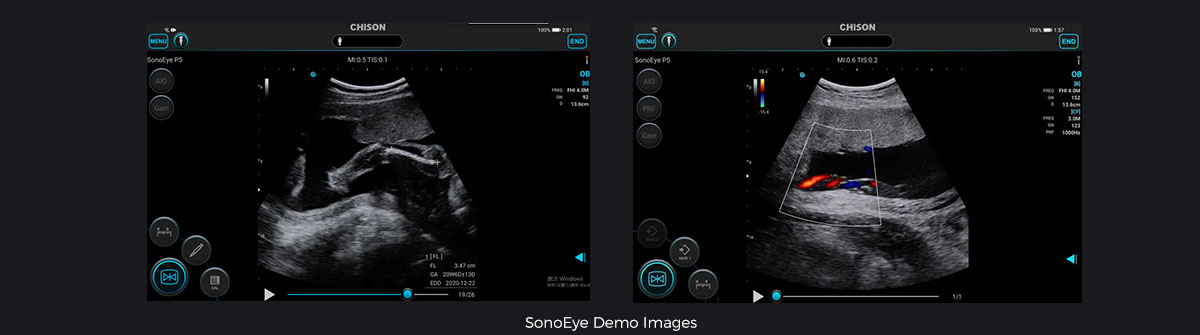 SonoEye 在产科中的应用 SonoEye 在产科中的应用