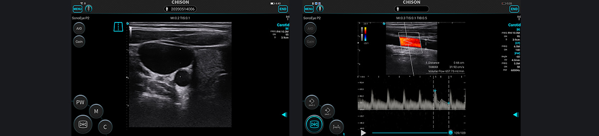 SonoEye ��Ѫ�ܳ����е�Ӧ��